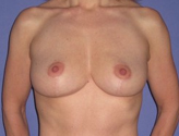 Patient # 26182 After Photo # 2